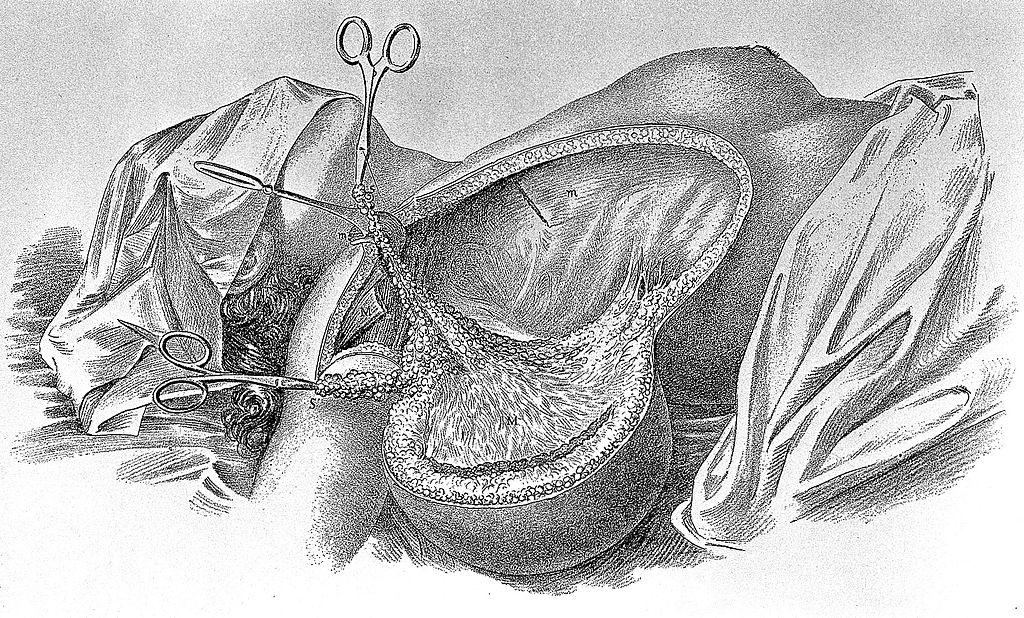 William Stewart Halsted, Surgical papers